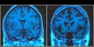 Brain circuit changes: Permanent or Transient